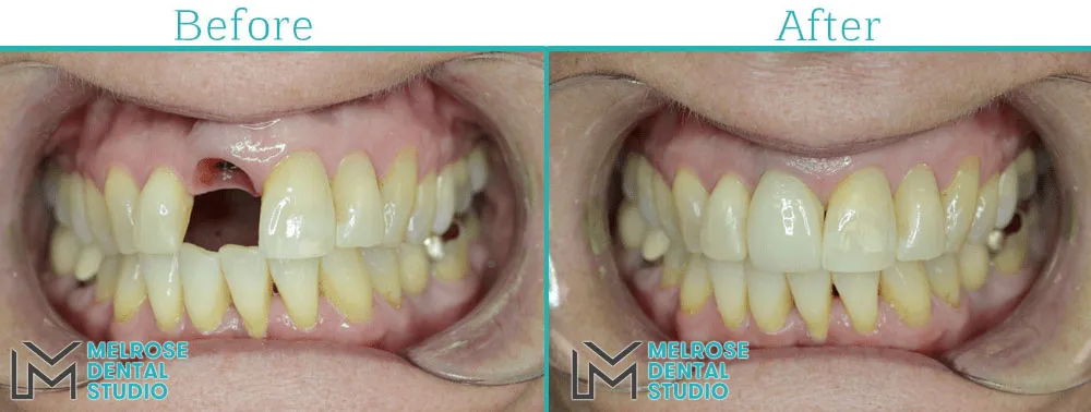 Before and after of a smile restored with Nobel Biocare dental implants, case 2